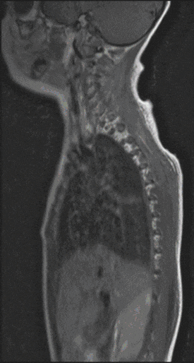 Rueckenmarkstumore-Kinder Rueckenmarkstumore-Kinder