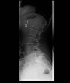 Spondylolisthese I